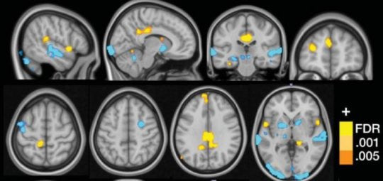 Neural Signature for Fibromyalgia May Aid Diagnosis and Treatment